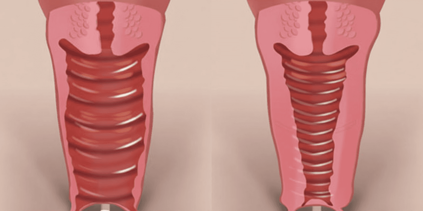 ビビブ施術前後