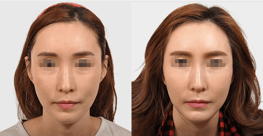 コラーゲン注射 #1 施術後