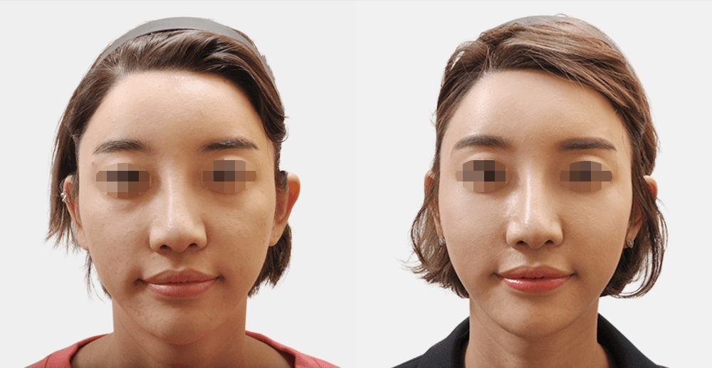 コラーゲン注射 #2 施術3ヶ月後