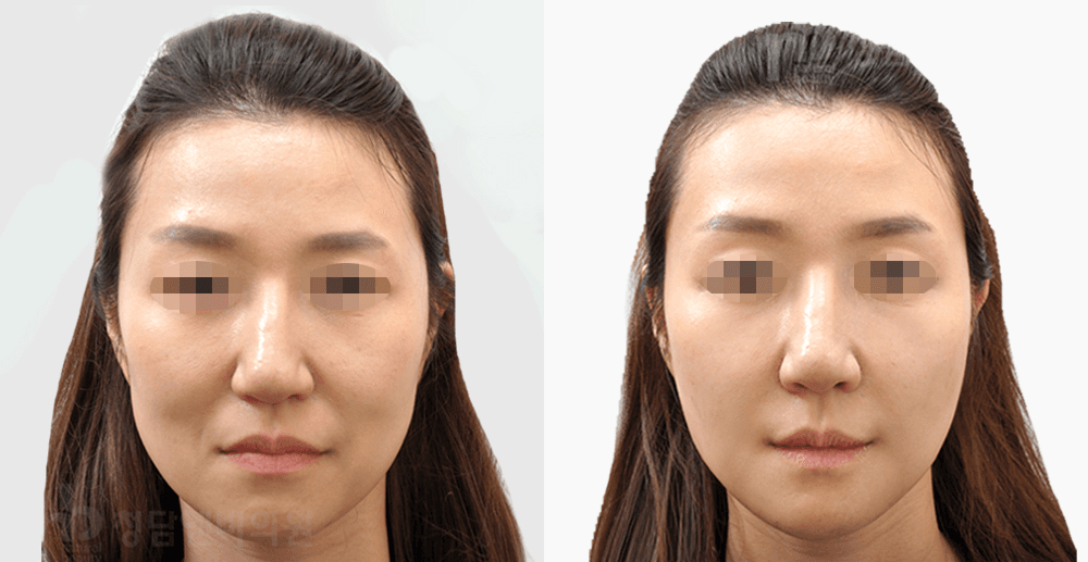 コラーゲンタッチ #1 施術1ヶ月後