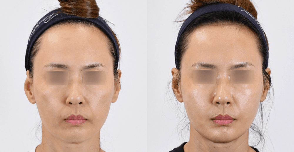 コラーゲンタッチ #2 施術1ヶ月後