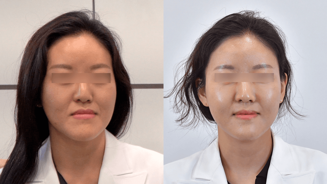 コラーゲンタッチ #3 施術後