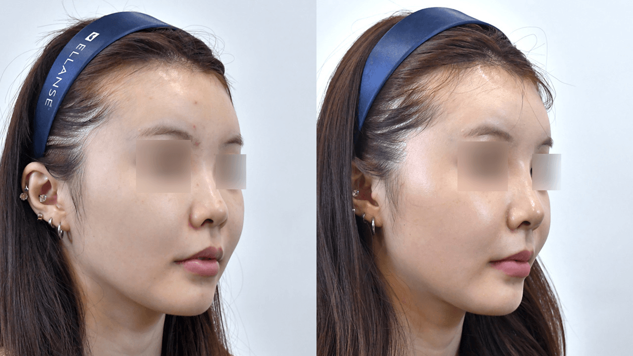 マジックノーズ #1 施術1週間後 (45°)