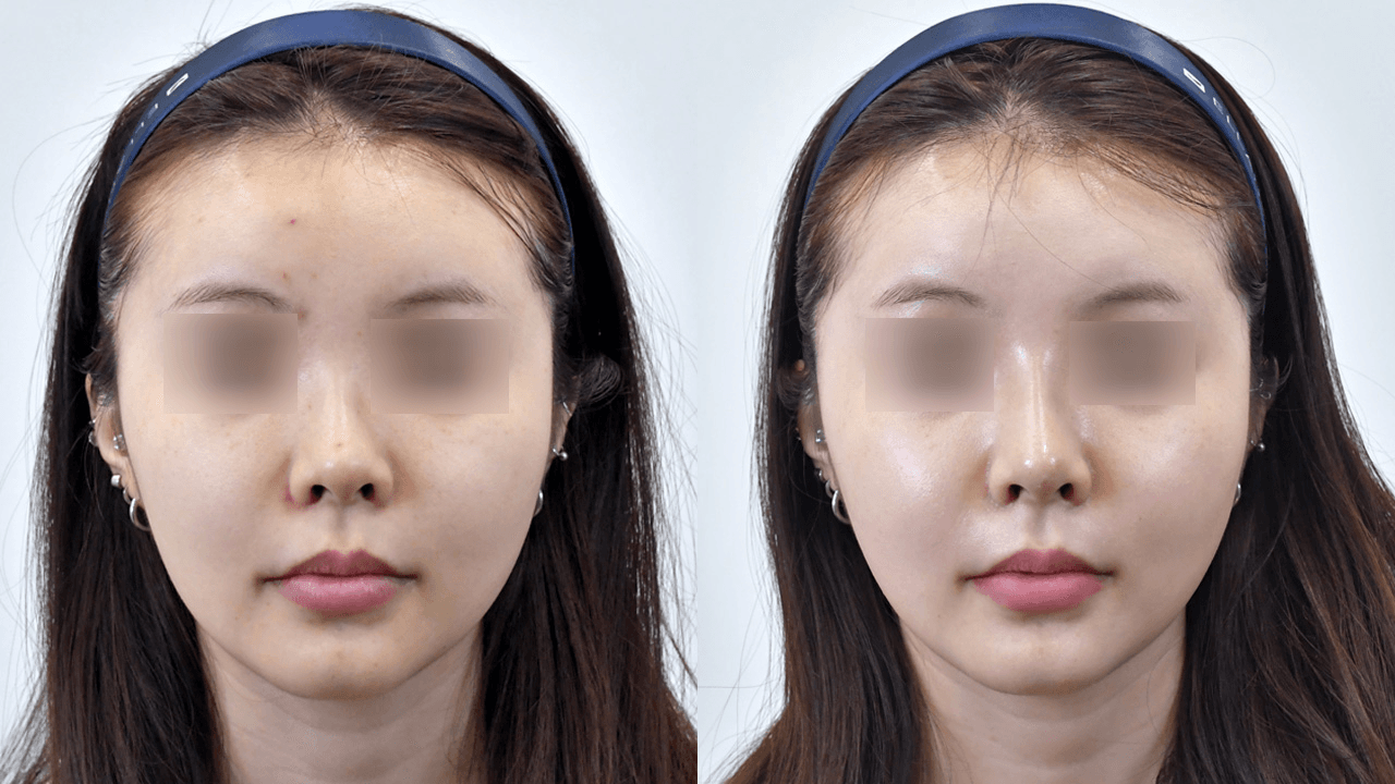 マジックノーズ #1 施術1週間後