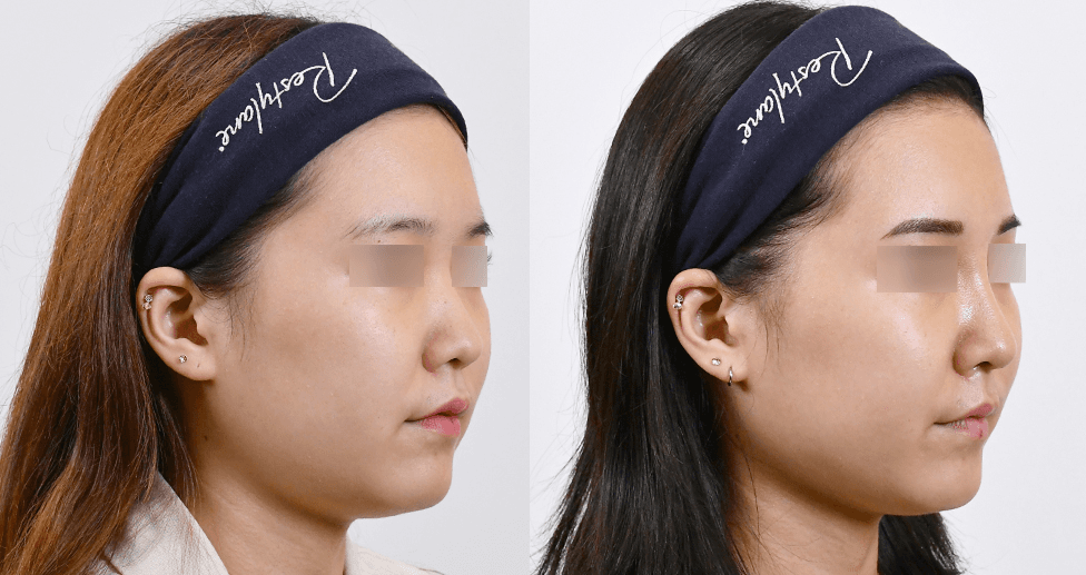 魔法鼻 #2 治疗1个月后 (45°)