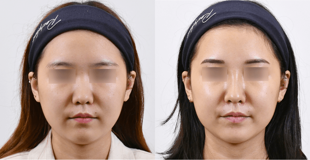 マジックノーズ #2 施術1ヶ月後