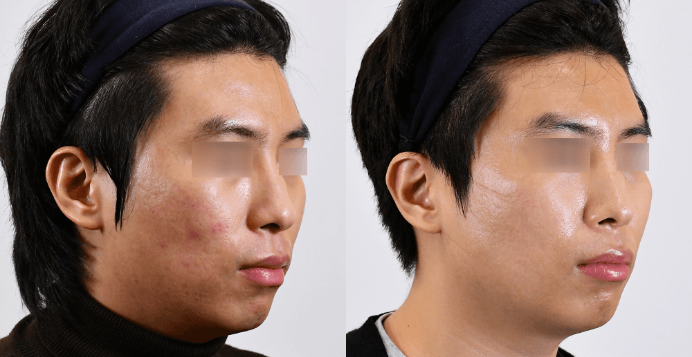 疤痕/毛孔 #1 治疗6个月后 (45°)