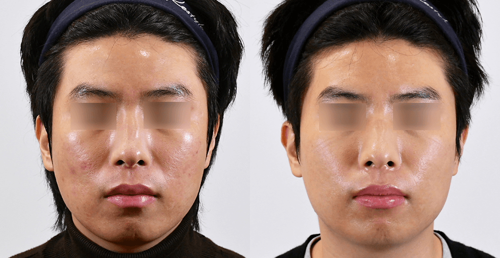 疤痕/毛孔 #1 治疗6个月后