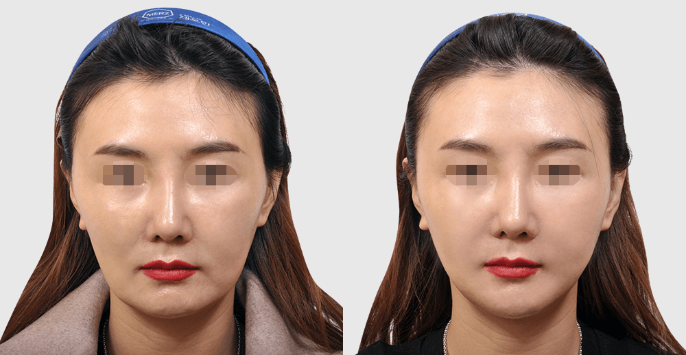 线雕提升 #1 治疗1年后