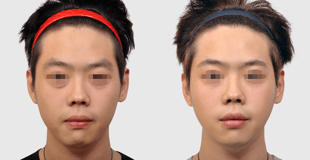 线雕提升 #2 治疗1个月后