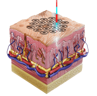 프랙셔널 레이저 기술