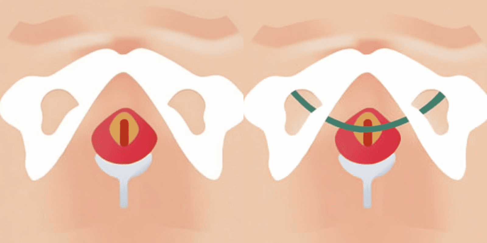 尿失禁Mini Sling手术前后
