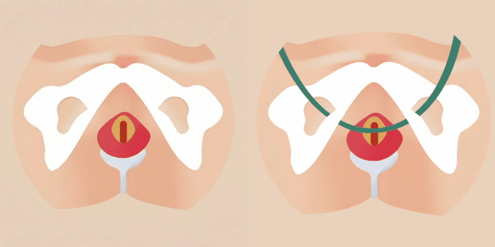 尿失禁TOT手术前后