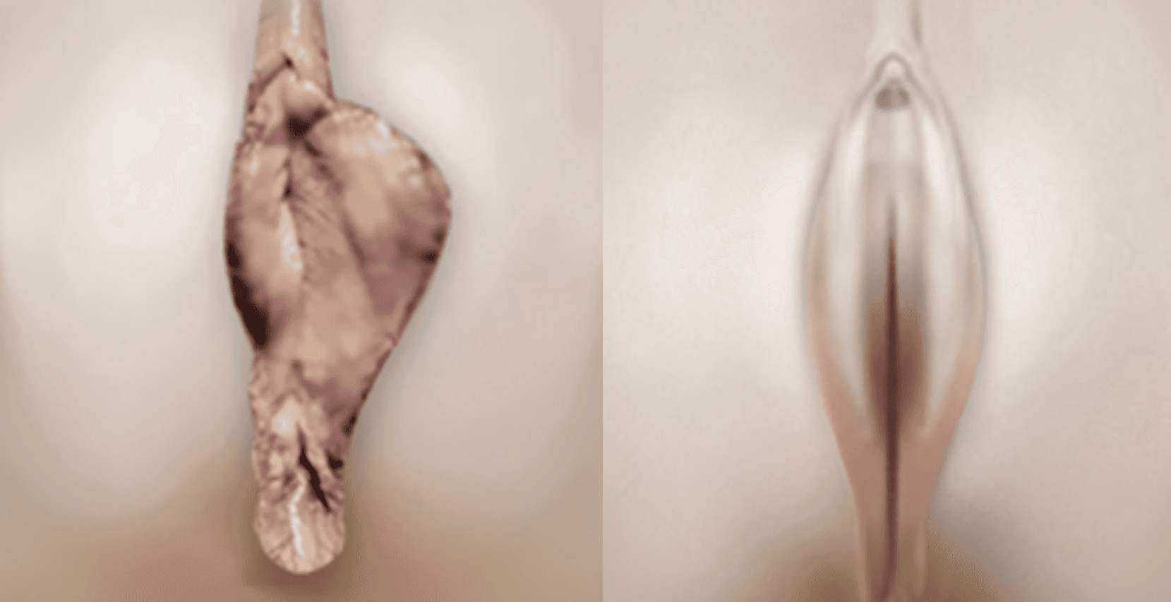 소음순 성형 시술 전후 (1)