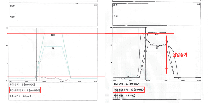 질압 개선 사례 1