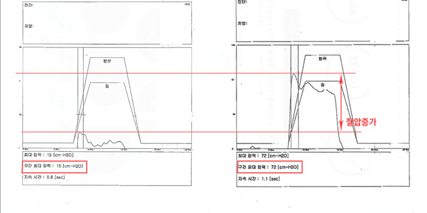 질압 개선 사례 2