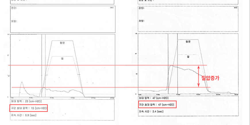 질압 개선 사례 3