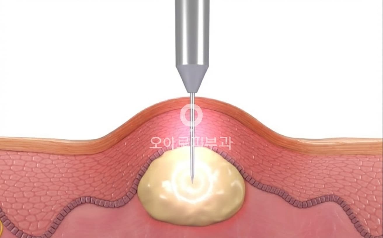 고주파 피지선 선택적 파괴