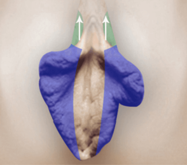 Surgical Design & Clitoral Exposure