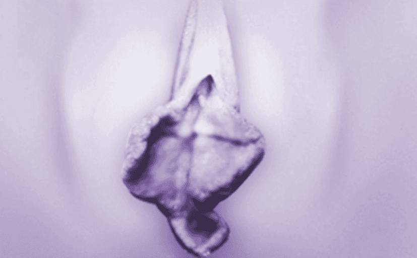 양쪽 비대 소음순