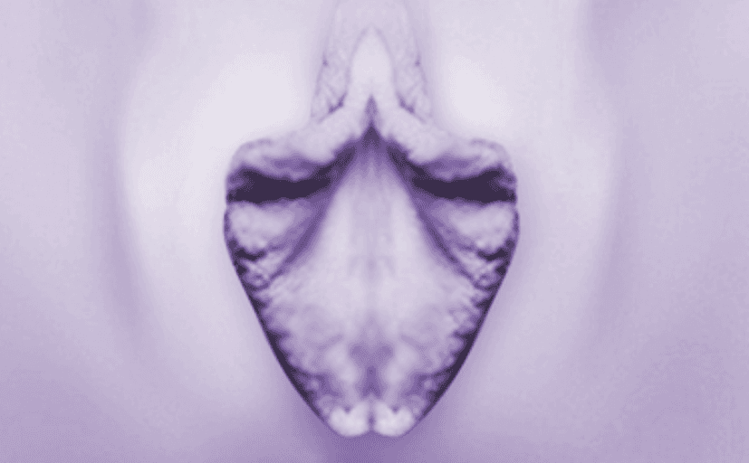 양쪽 비대 + 음핵 덮개 연결